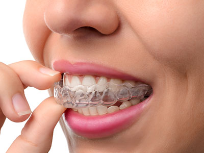 A woman with clear aligners on her teeth, holding them up to her mouth with a thoughtful expression.