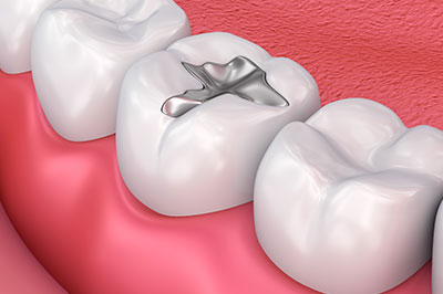 The image shows a close-up view of a dental implant inserted into a tooth within an oral cavity with visible gum tissue and teeth on either side, set against a pink background that may represent a mouth lining.