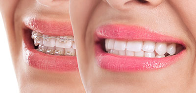 The image shows two close-up photographs of a smiling person with pink lipstick, placed side by side.