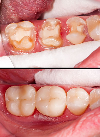 The image shows a close-up view of a person s teeth with visible signs of decay and damage, including cavities and discoloration, set against a medical context that suggests dental care or treatment.