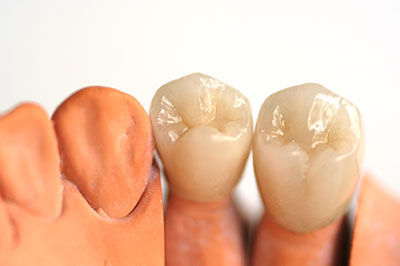 The image shows a set of dental implants with fake teeth, displayed in a row against a white background.