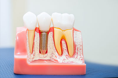 The image shows a dental model with artificial teeth and roots, some of which have screws inserted into them, placed on a pink base that resembles gum tissue.