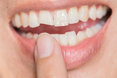 The image shows a person holding their finger over their lips with a smile, revealing a dental implant in progress.