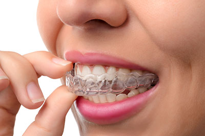 A person wearing clear braces with straight white teeth is holding their finger under their chin, seemingly contemplating something.