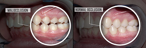 The image shows two photos of a person s teeth with labels indicating normal occlusion and malocclusion.