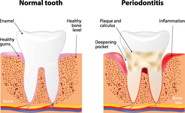 The image displays a diagrammatic illustration of the stages of tooth decay progression from normal to periodontitis, with annotations for healthy bone, plaque buildup, inflammation, and tooth decay at various levels.