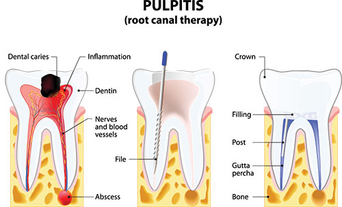 The image displays a diagrammatic illustration of a dental root canal procedure, showing the process from preparation to completion with labeled parts such as  crown,   infarction,   dentin,   filling,  and  file.