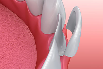 The image shows a close-up view of a dental implant fixture with a pink gum background and a metal abutment piece visible, indicating a preparation for a dental implant procedure.