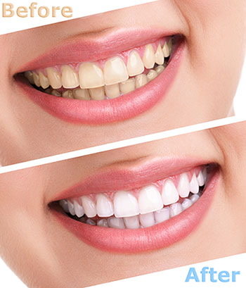 The image displays a before-and-after comparison of dental whitening treatment, showcasing a significant improvement in tooth color after the procedure.